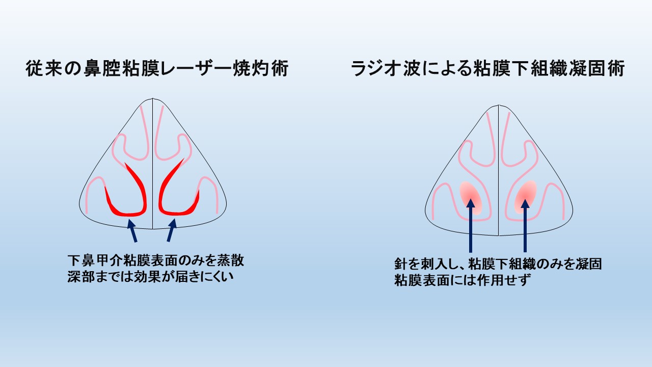 鼻 の 粘膜 焼く