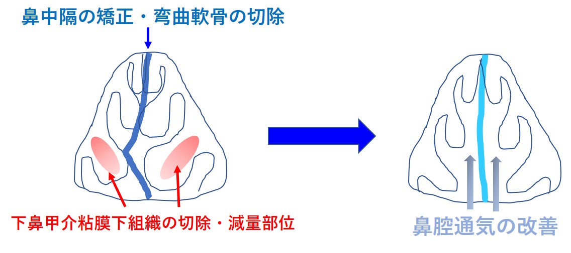 鼻 の 中 かさぶた